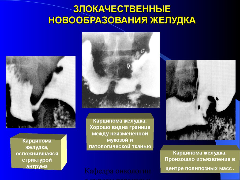 Опухоль желудка. Новообразование в желудке. Злокачественная опухоль желудка. Злокачественное новообразование желудка. Раковая опухоль желудка.