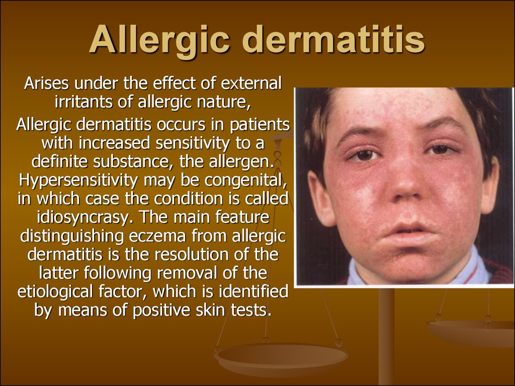 Eczema. Dermatitis - презентация онлайн