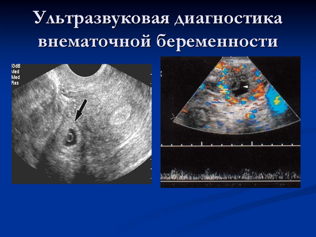 Как отличить на узи. Внематочная Трубная беременность УЗИ. УЗИ признаки трубной беременности. Внематочнаябкременность УЗИ. Внематочная беременность на УЗИ.