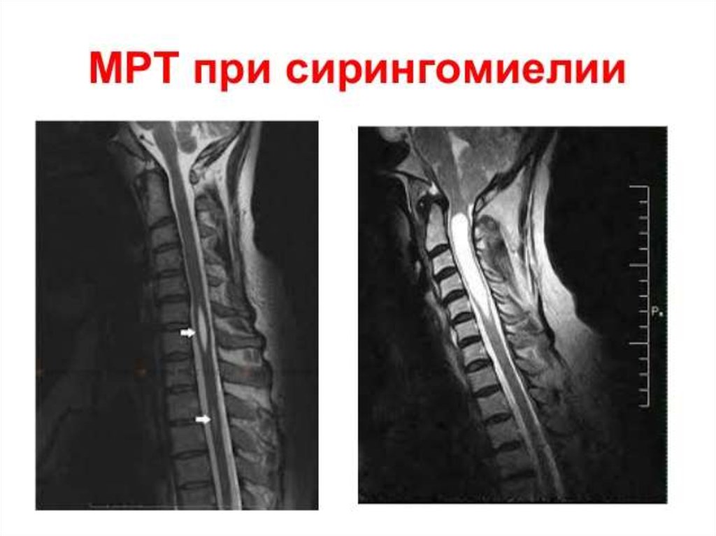 Киста шейного отдела позвоночника