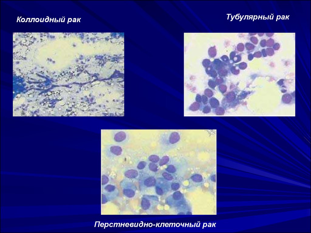 Коллоидного железа. Перстневидно клеточная карцинома. Перстневидные клетки в мокроте. Перстневидные клетки микропрепарат.