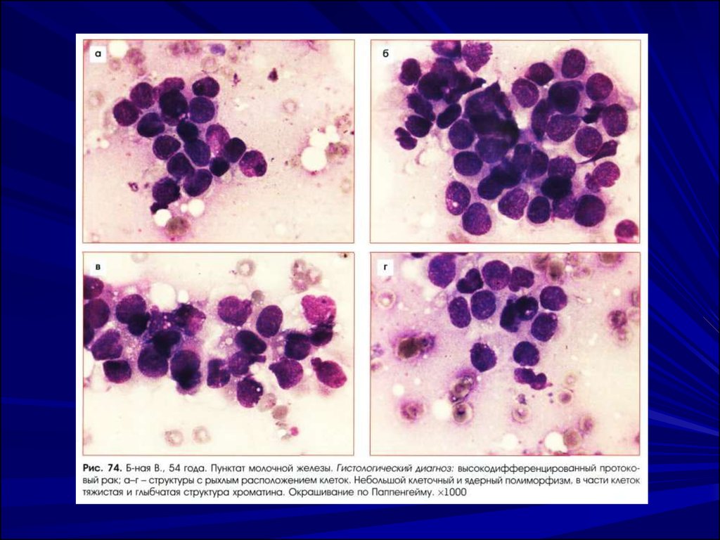 Цитологическим исследованием полученного материала. Клетки молочной железы цитология. Карцинома молочной железы цитология. Цитология пунктата молочной железы.