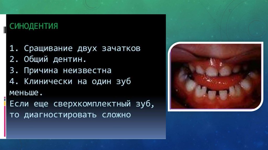 Аномалии формы зубов - презентация онлайн