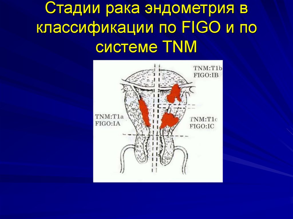 1 фаза эндометрия. Классификация TNM опухолей матки. Классификация стадий эндометрия. Эндометриальная карцинома стадии.