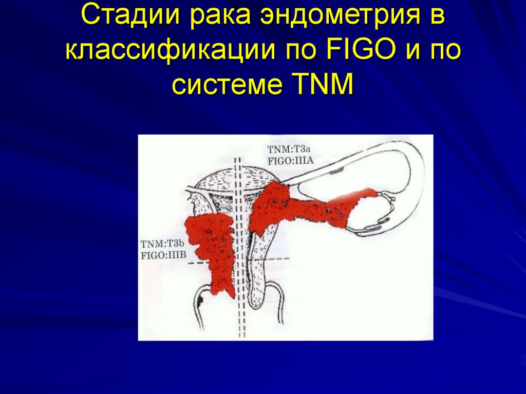 1 фаза эндометрия. Классификация стадий эндометрия. Классификация TNM опухолей матки. Классификация Figo тело матки.