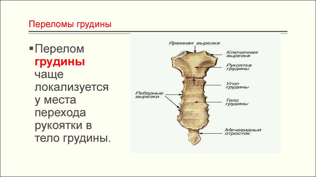 Перелом грудины презентация