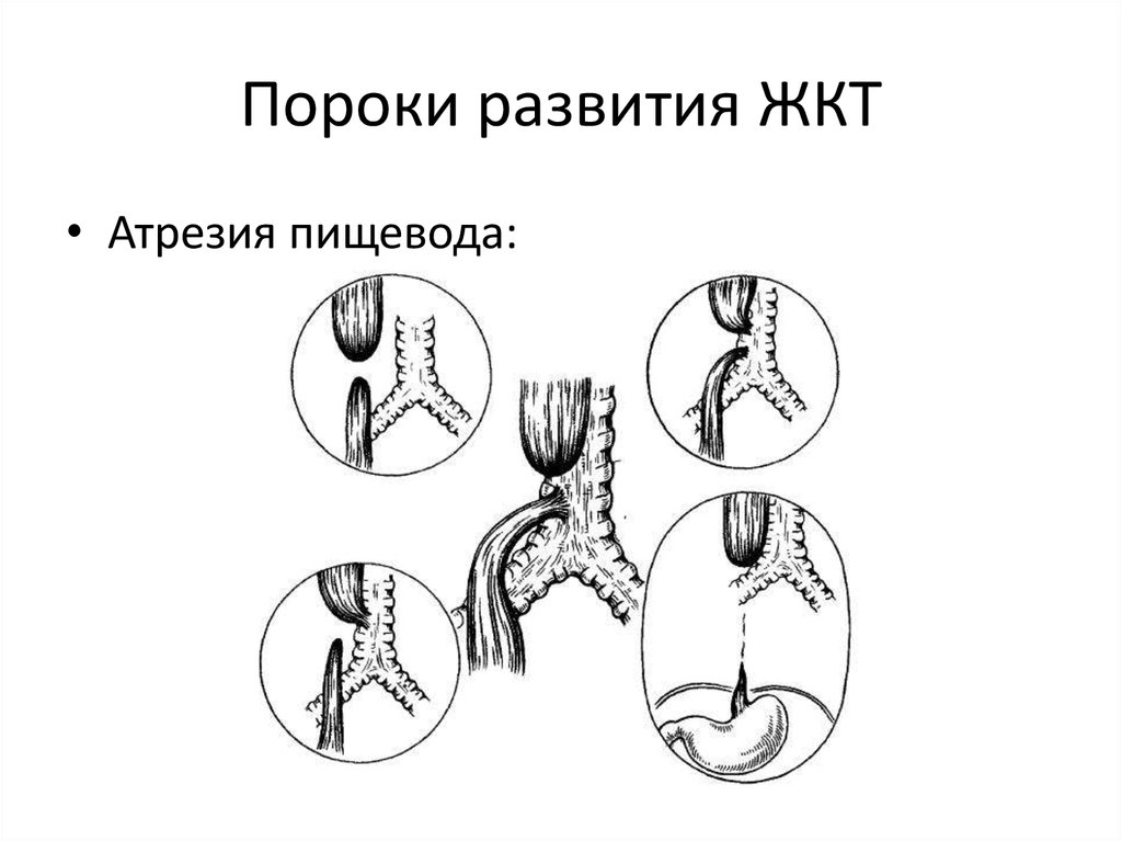 Атрезия прямой кишки. Пороки развития желудочно-кишечного тракта. Аномалии развития желудочно кишечного тракта. Врожденные пороки развития ЖКТ. Пороки развития кишечного тракта.