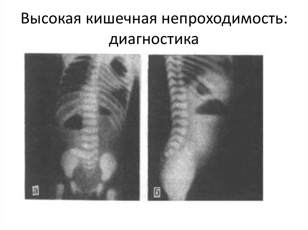 Приобретенная кишечная непроходимость у детей презентация