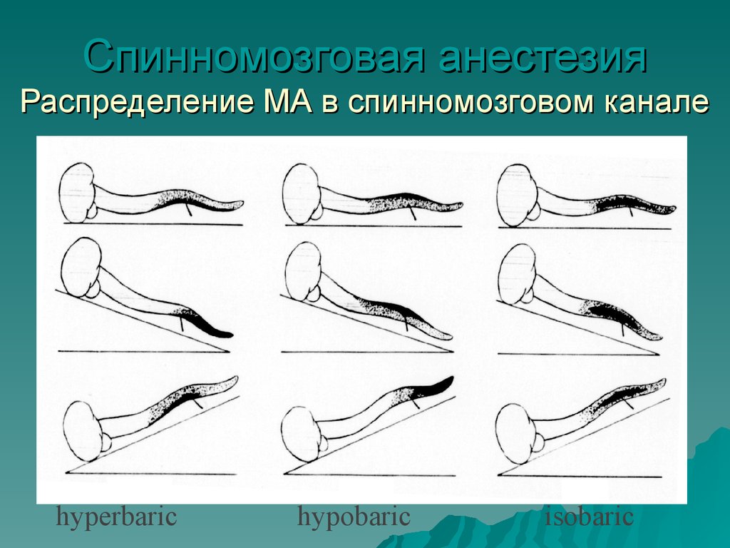 Спинномозговая анестезия. Нейроаксиальная анестезия. Спинальная и региональная анестезия.