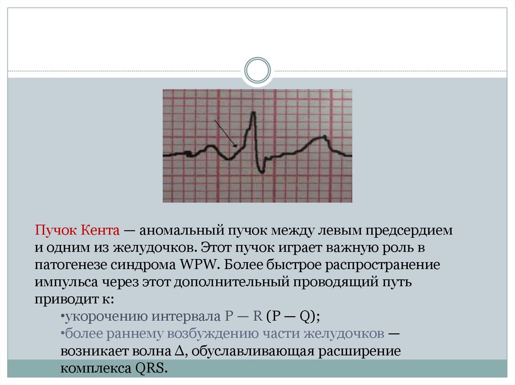 Нарушения пучка. ВПВ синдром пучок Кента ЭКГ. Пучок Махайма на ЭКГ. Пучок Махейма ЭКГ. Дополнительный пучок Кента на ЭКГ.