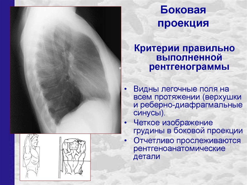 Боковая проекция. Рентген ОГК боковая проекция. Рентген боковая проекция легкие норма. Рентген легких боковая проекция норма. Рентген грудной клетки в боковой проекции норма.