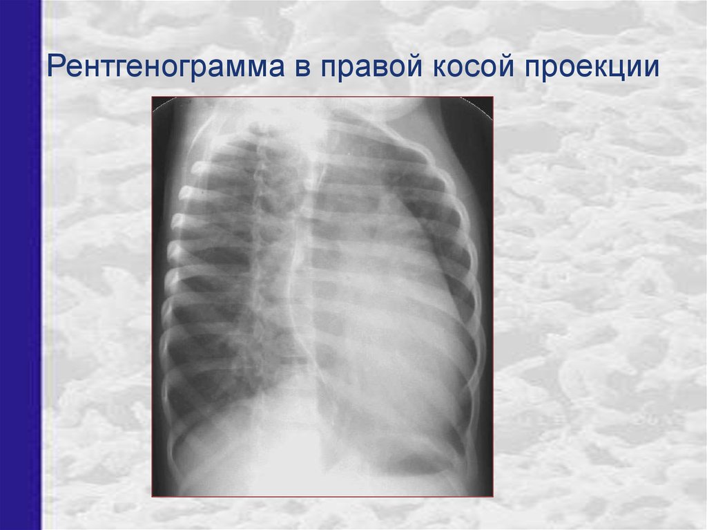 Прямая проекция рентгенограмма. Косая рентгенограмма грудной клетки. Рентгенограмма грудной клетки в косой проекции. Рентген ребер косая проекция. Косая проекция рентген легких.