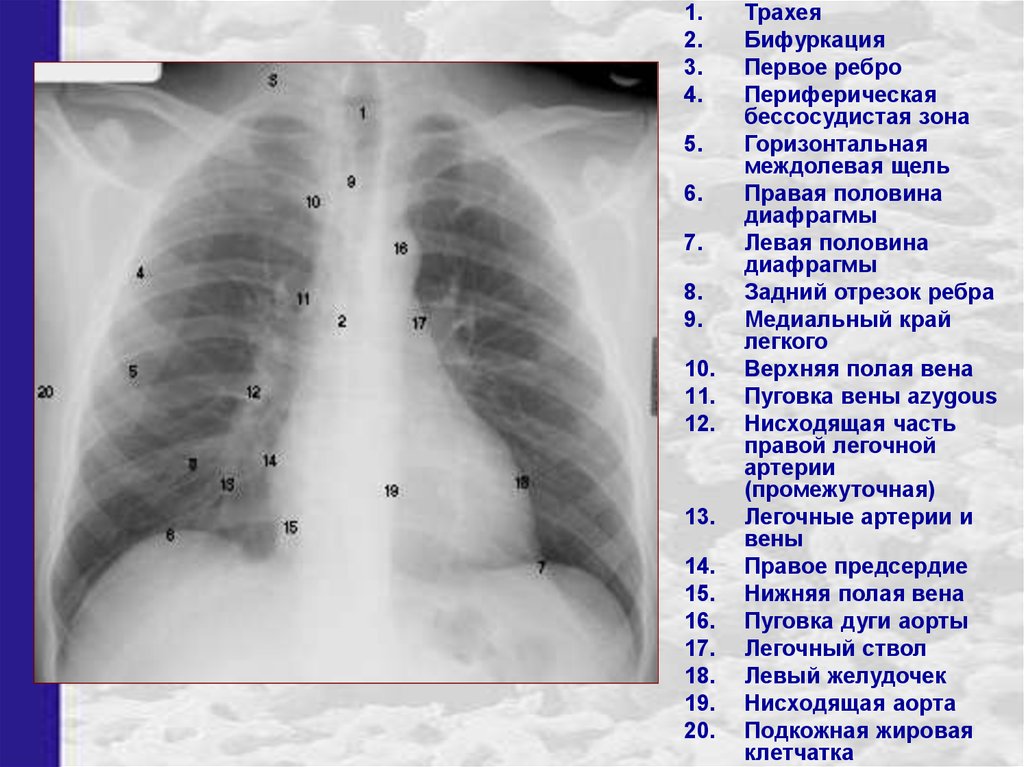 Правая зона. Ребра рентген анатомия. Рентген грудной клетки анатомия. Передние отрезки ребер на рентгенограмме. Грудина анатомия рентген.