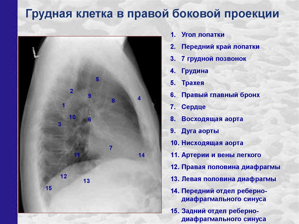 Рентген легких схема