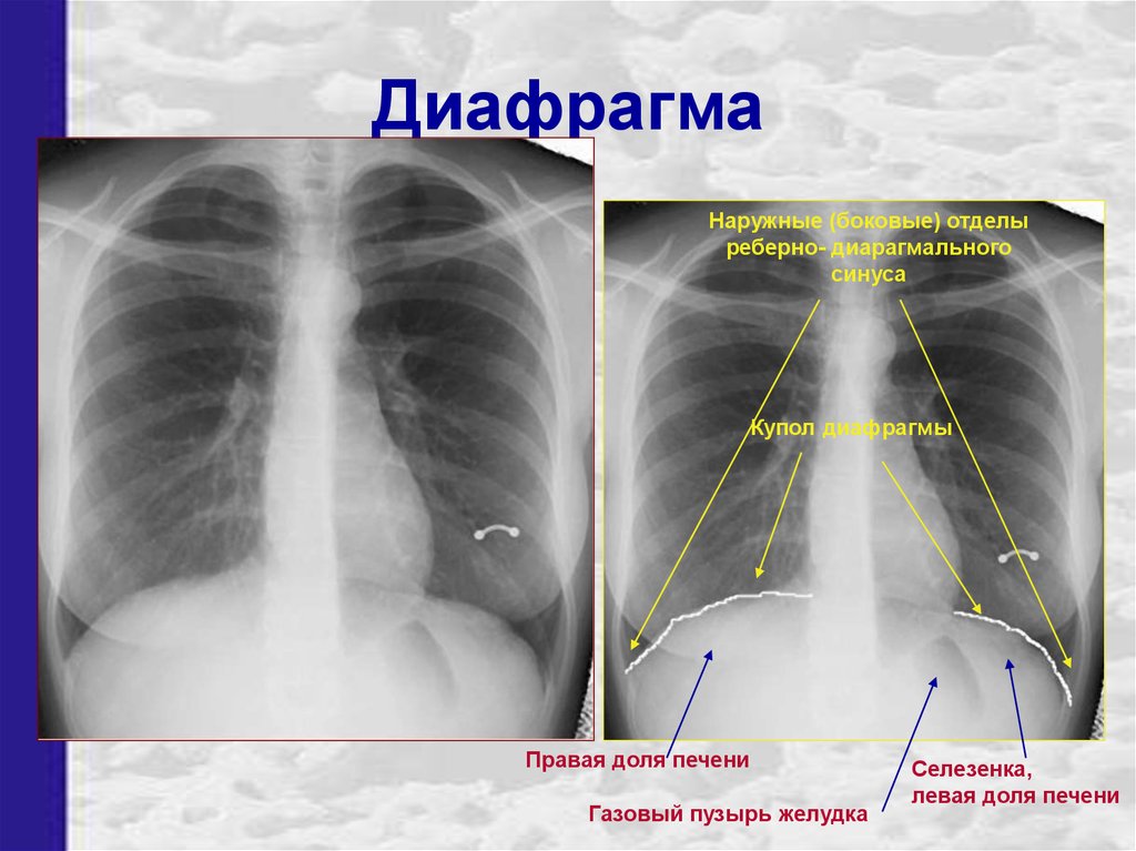 Угол справа. Диафрагмальные синусы на рентгенограмме. Реберно диафрагмальный синус на рентгенограмме. Плевральные синусы на рентгенограмме.