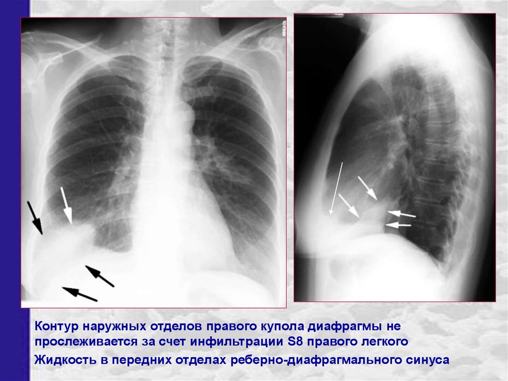 Синусы рентген. Спайки диафрагмы на рентгене. Диафрагма на рентгене легких. Синус в рентгене лёгких.