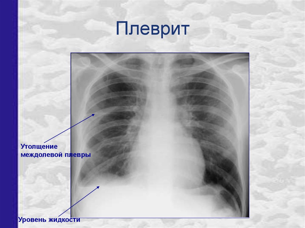 Экссудативный плеврит рентгенологическая картина