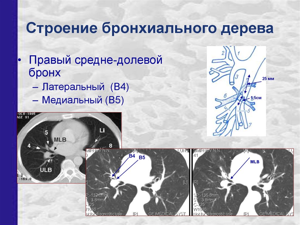 Бронхи схема кт