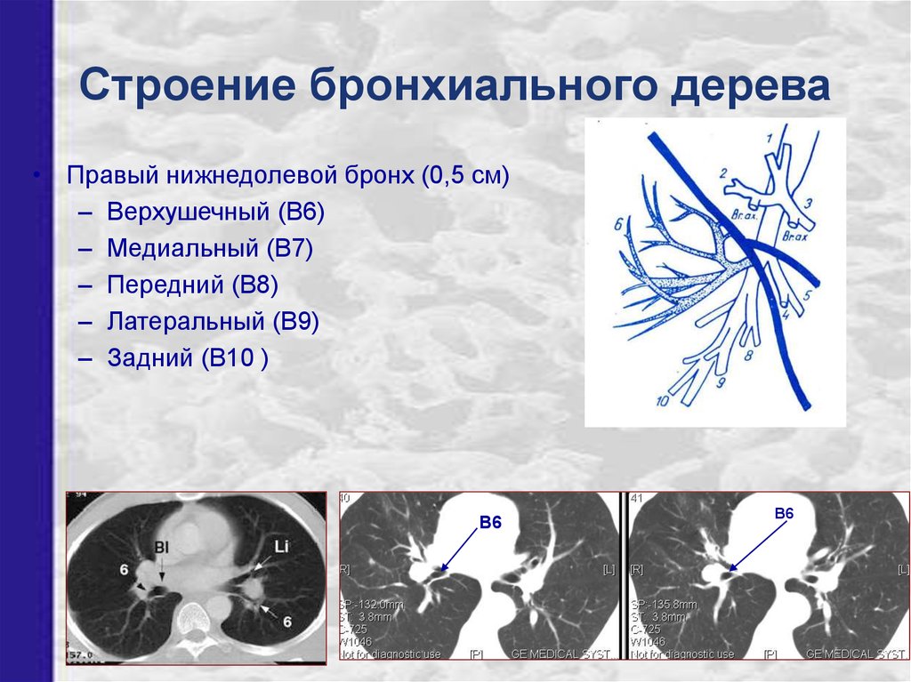 Бронхи на кт схема