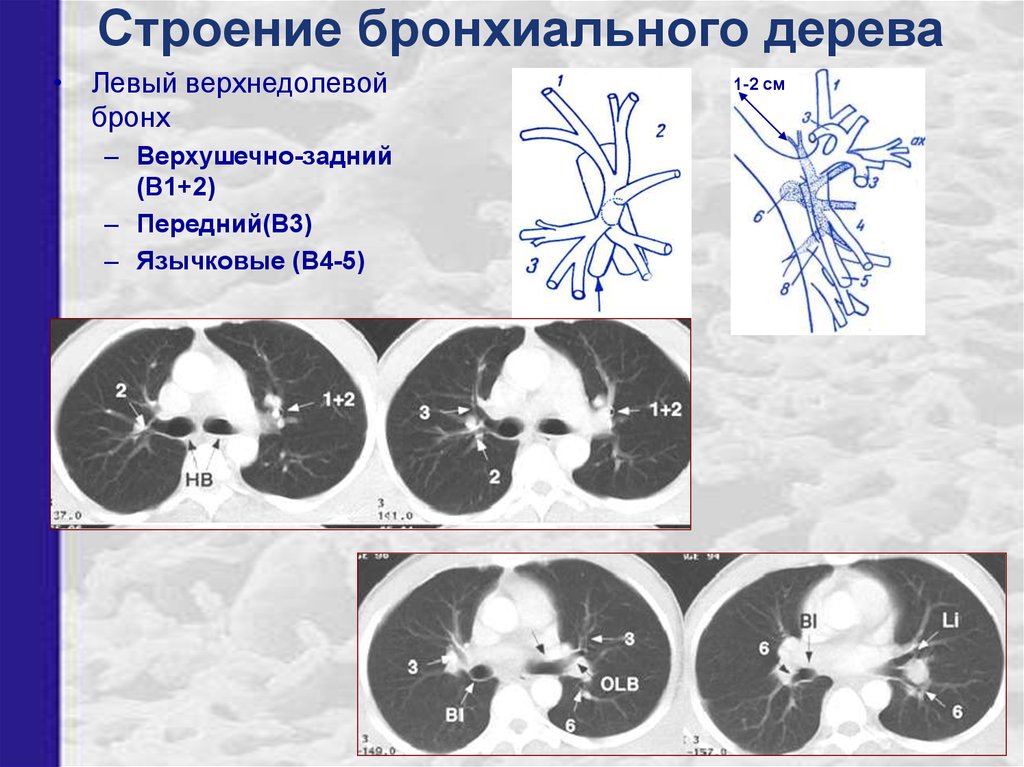 Сегменты легких кт схема