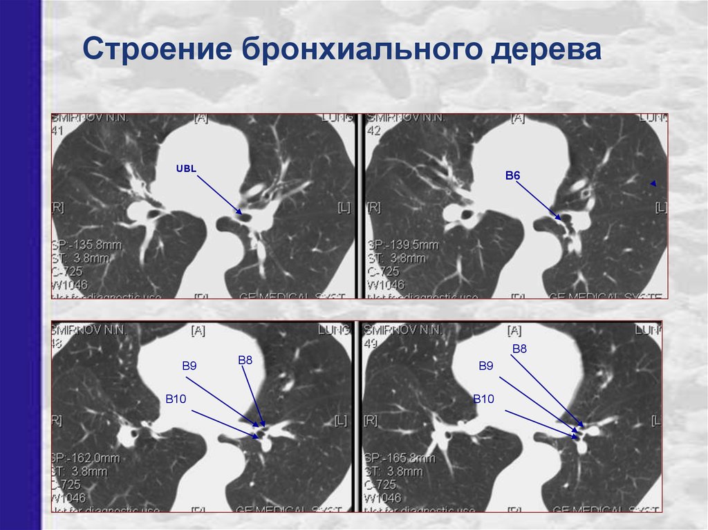 Бронхи на кт схема