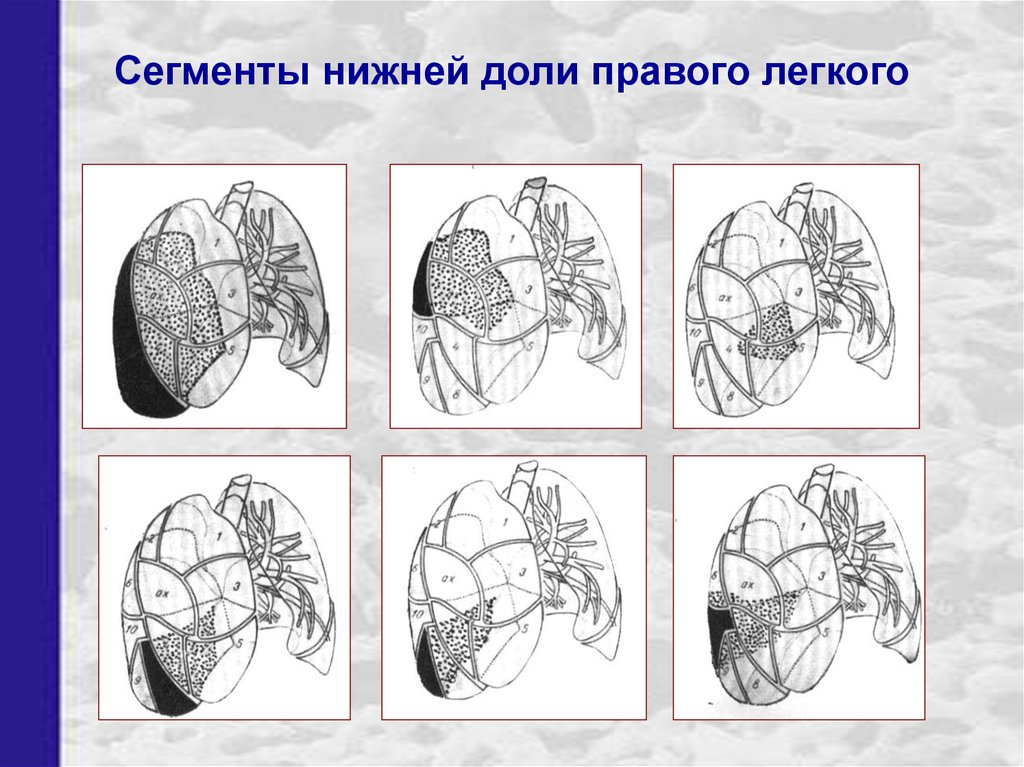 Нижние сегменты легкого. Сегменты нижней доли правого легкого. Легочные сегменты на кт. Сегменты лёгких схема.