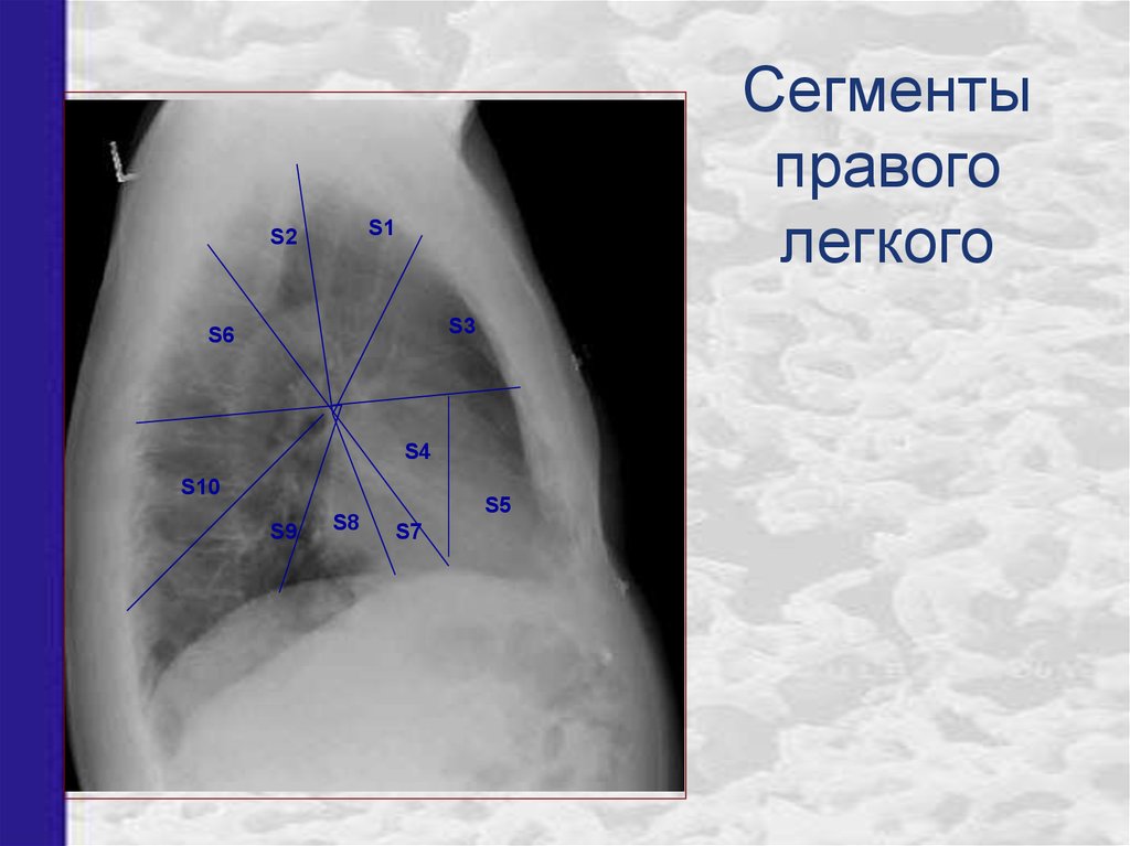 Сегменты легких на рентгенограмме схема