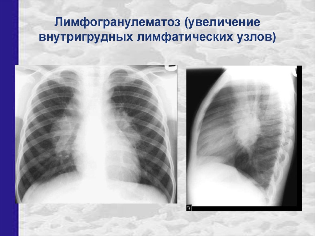 Легкие увеличен узел. Лимфогранулематоз рентген легких. Лимфогранулематоз средостения рентген. Лимфогранулематоз лёгких на рентгене. Лимфома Ходжкина рентген легких.