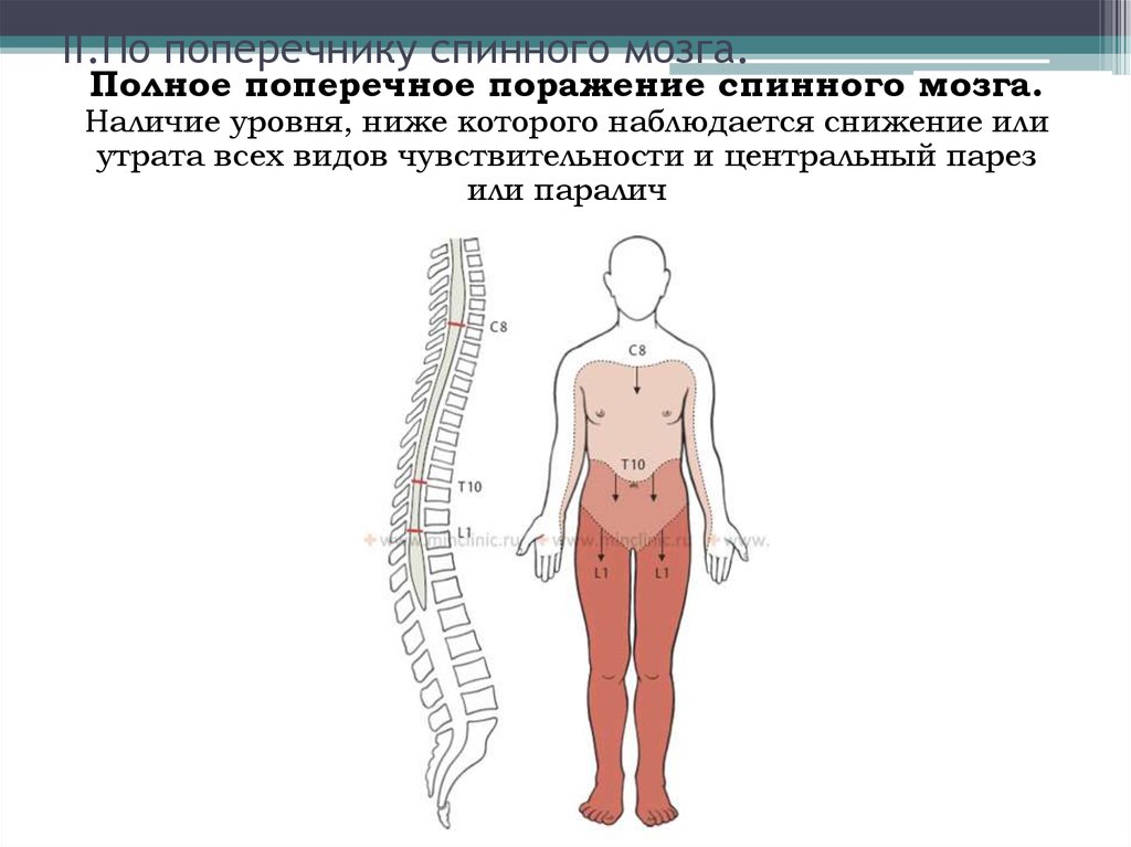 Поражение спинного. Полное поражение поперечника спинного мозга. Симптом поперечного поражения спинного мозга. Повреждение спинного мозга l2 l3. Спинной мозг на уровне l4- s2.
