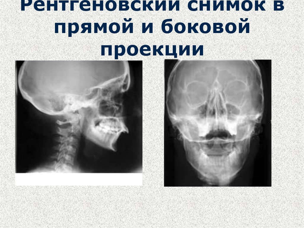 Рентген носоглотки ребенку. Рентген пазух носа боковая проекция. Рентген снимок сбоку здорового носа. Рентген нормального носа сбоку. Рентген ППН В боковой проекции.