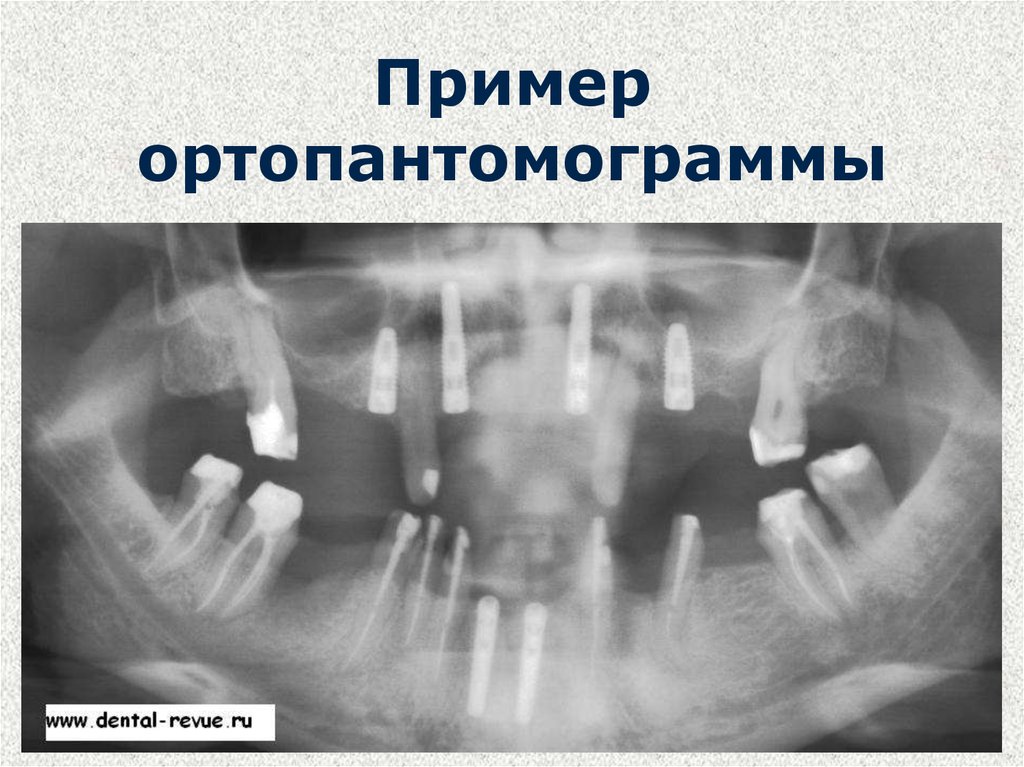 Схема описания ортопантомограммы