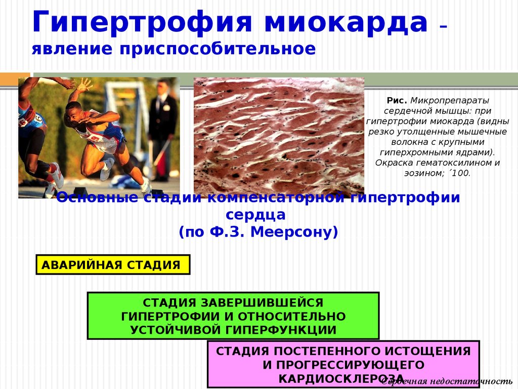 Стадии компенсаторной гиперфункции миокарда. Гипертрофия миокарда патофизиология. Стадии гипертрофии. Стадии становления гипертрофии миокарда.