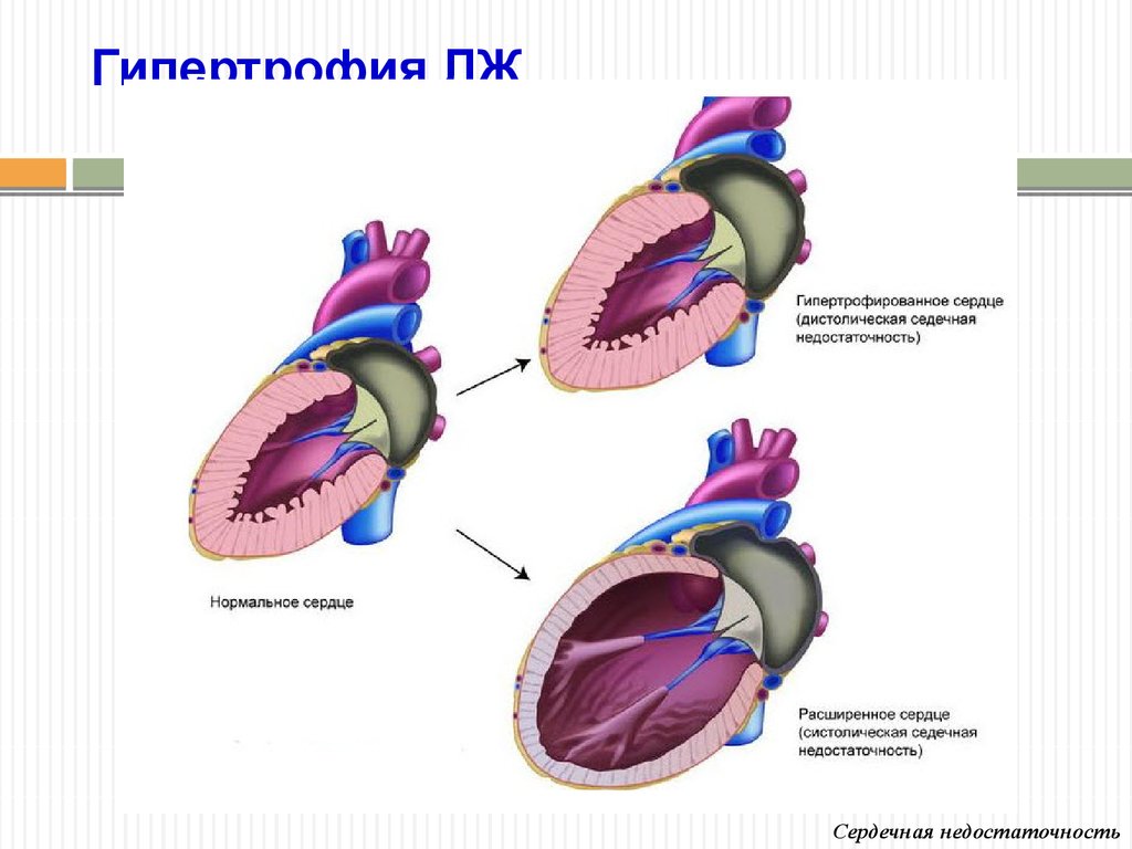 Малая сердечная недостаточность. Ремоделирование сердца патофизиология. Ремоделирование сердца и ХСН. Сердечная недостаточность. Ремолелирование сердце.