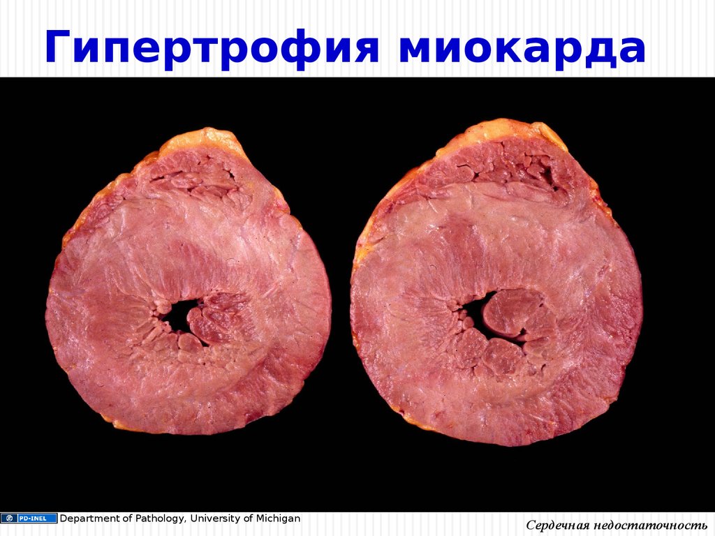 Гипертрофия миокарда. Гипертрофия левого желудочка макропрепарат. Гипертрофия миокарда макропрепарат. Концентрическая гипертрофия миокарда макропрепарат. Гипертрофия и гиперплазия патанатомия.