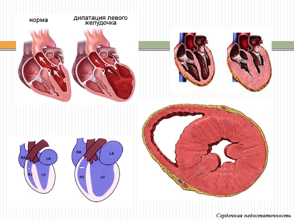 Дилатация сердца. Острая сердечная недостаточность левого желудочка. Серная недостаточность. Снрдечнаянедостаточность.