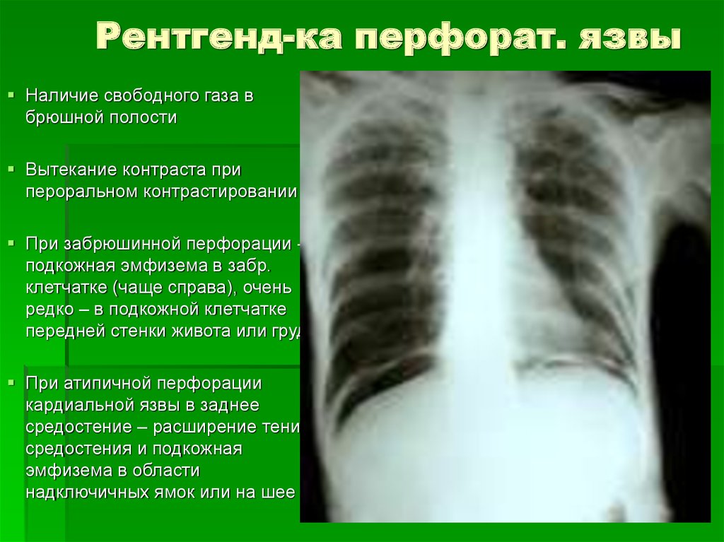 Кт при перфорации язвы желудка.