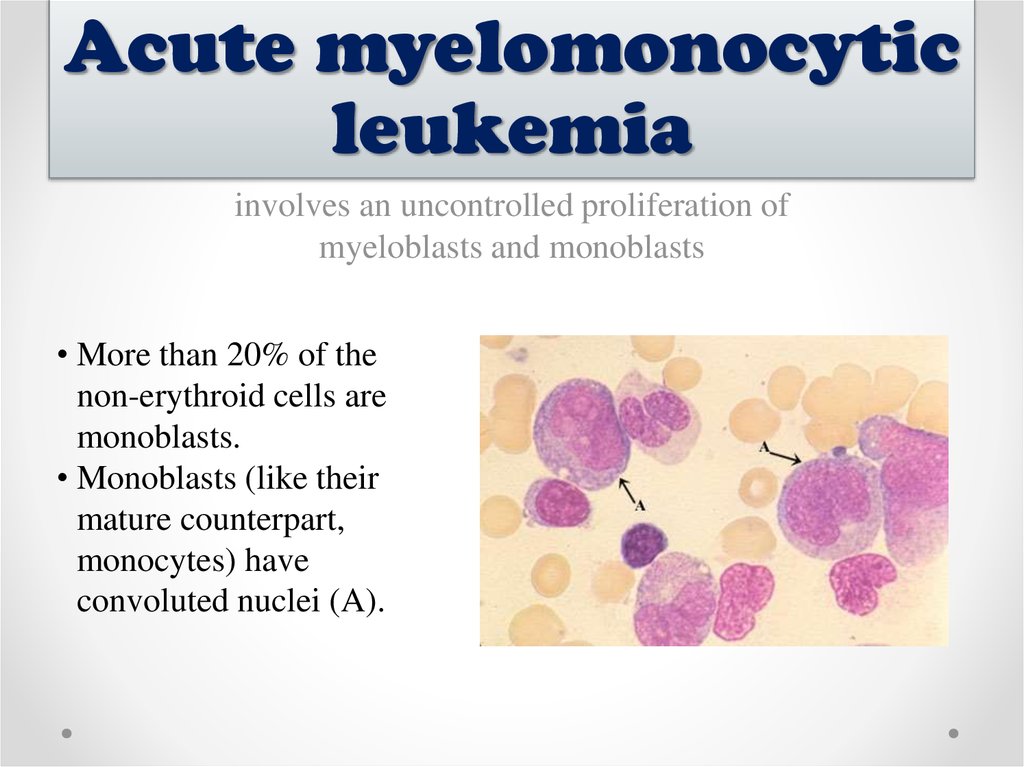 Acute myeloid leukemia - презентация онлайн