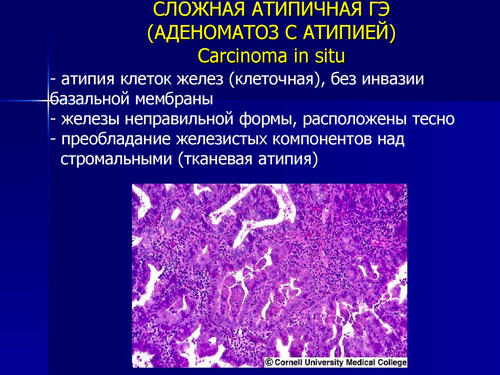 Отсутствуют клетки с признаками атипии. Микропрепарата железистая гиперплазия эндометрия. Атипическая гиперплазия эндометрия терапия. Гиперплазия эндометрия гистология. Эндометриальный полип матки гистология.