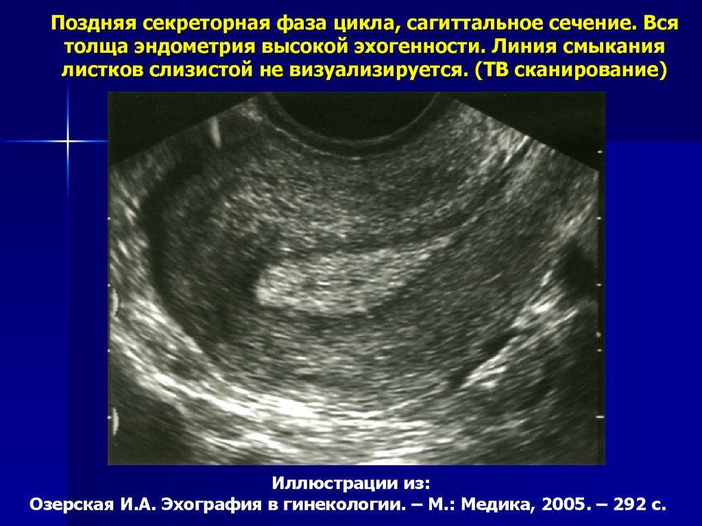 Эндометрий 24. Атипическая гиперплазия эндометрия УЗИ. Ранняя фаза секреции эндометрий УЗИ. УЗИ нормального эндометрия. Эндометрий по УЗИ по фазам цикла.