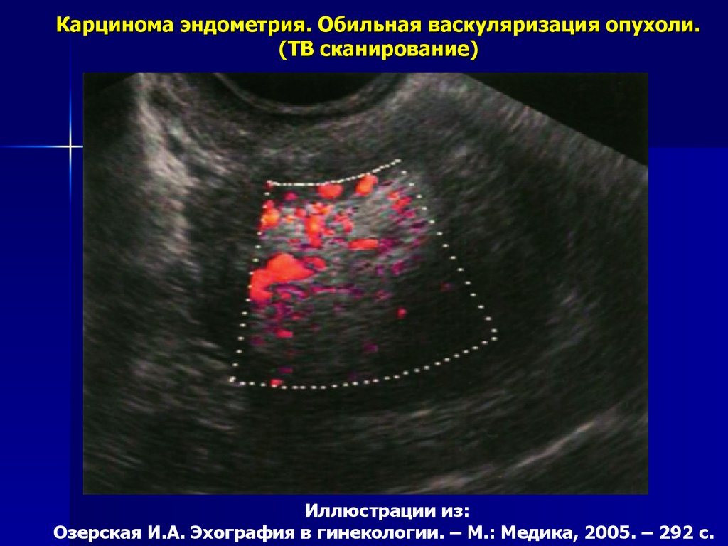 Эхограмма гиперплазии эндометрия. Васкуляризация эндометрия матки.