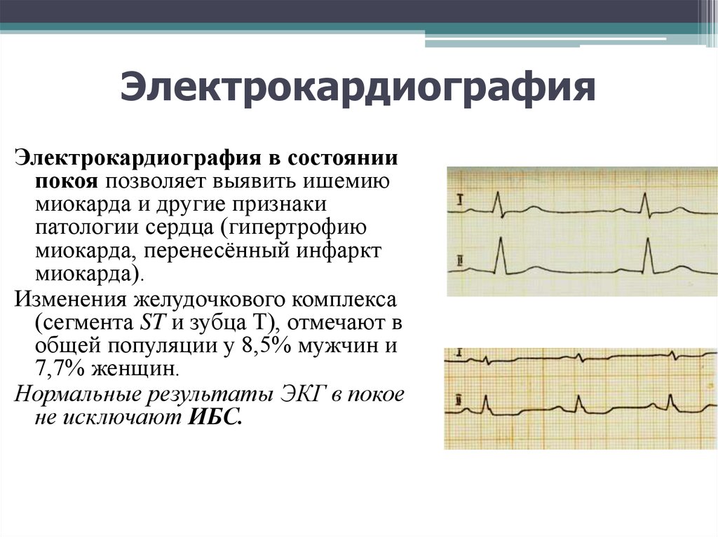Ибс на кардиограмме фото