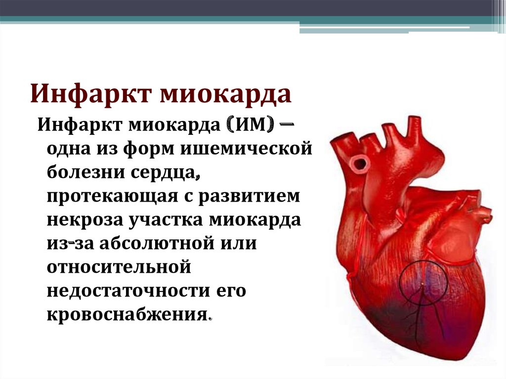 Оим это. Форма сердца при инфаркте миокарда. Причины развития острого инфаркта миокарда. Инфаркт миокарда форма ИБС. Острый инфаркт миокарда (ОИМ).