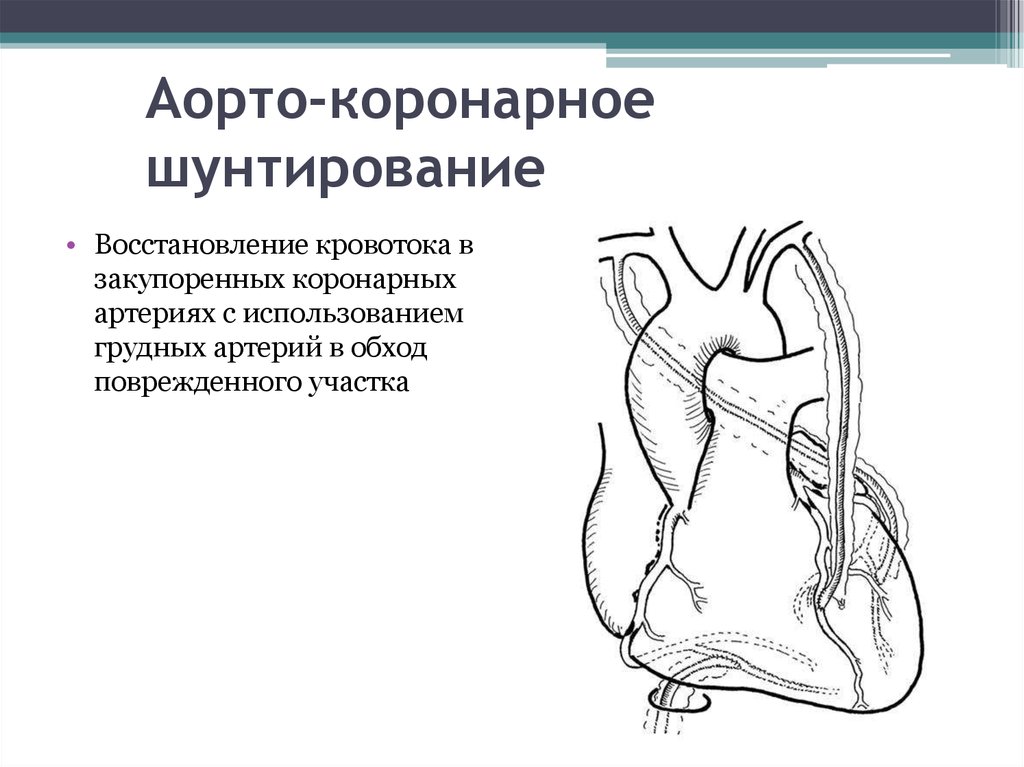 Что такое коронарное шунтирование. Схема операции аортокоронарного шунтирования. Билатеральное маммарокоронарное шунтирование. Аорто маммарно коронарное шунтирование. Аорто аортальное шунтирование.