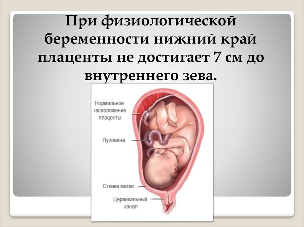Зев закрыт при беременности. Закрытие внутреннего зева. Плацента высоко от внутреннего зева. Плацента по передней стенке перекрывает внутренний зев. Что такое внутренний зев при беременности.