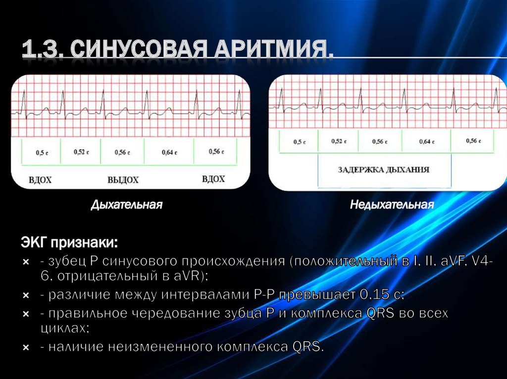 Синусовая аритмия сердца у подростка