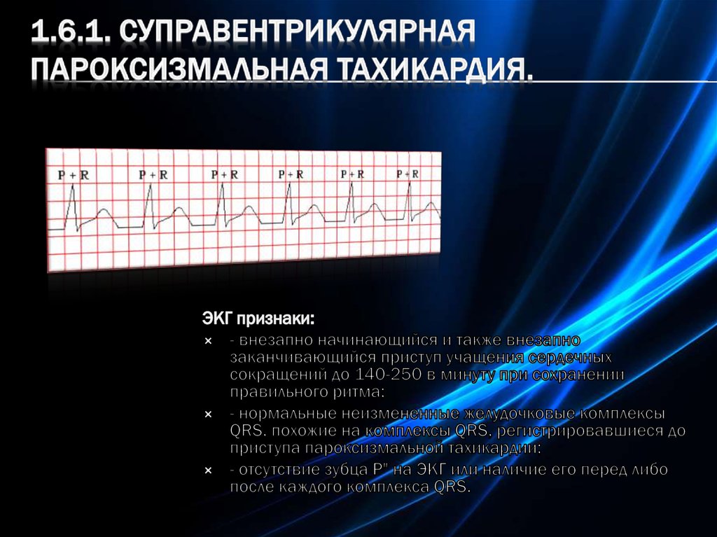 Экг картина при пароксизме суправентрикулярной тахикардии имеет вид