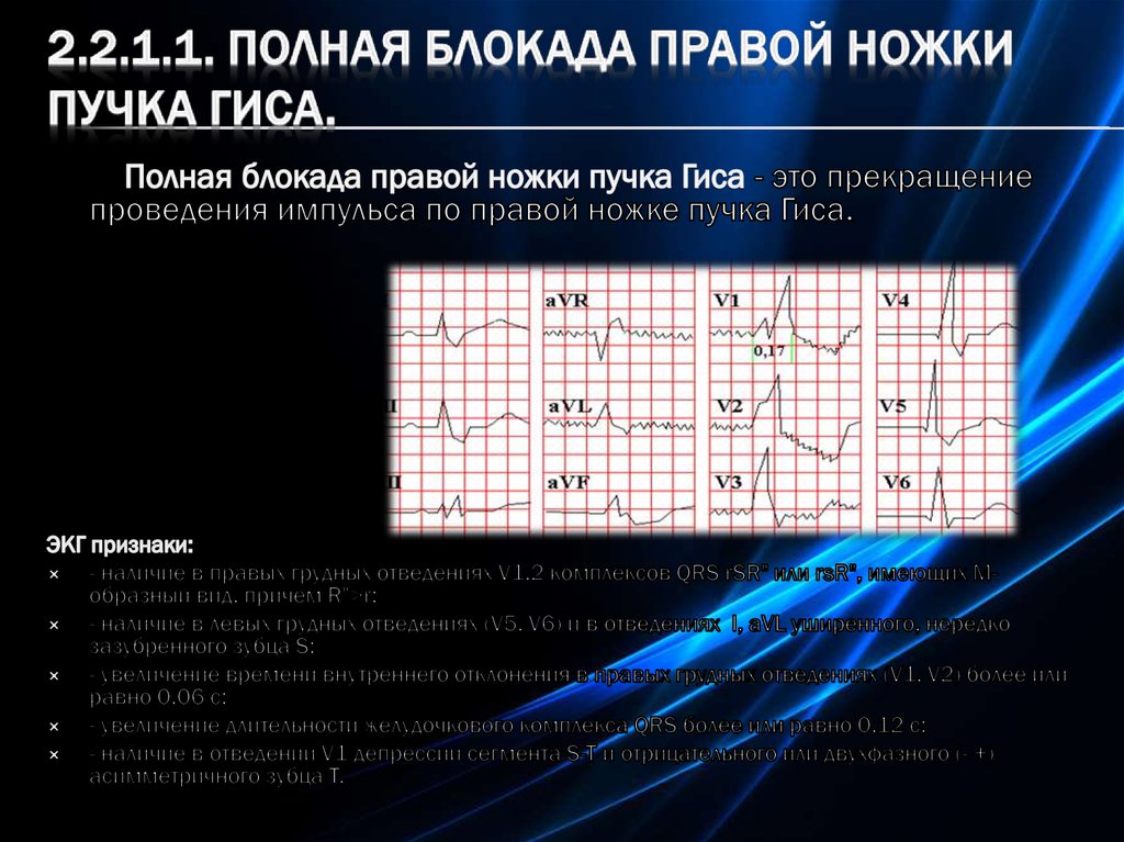 Блокада ножки пучка гиса мкб. Полная блокада правой ножки пучка Гиса. Полная блокада правой ножки пучка Гиса мкб 10. Полная блокада левой ножки пучка Гиса мкб. Блокада правой ножки пучка Гиса на ЭКГ.