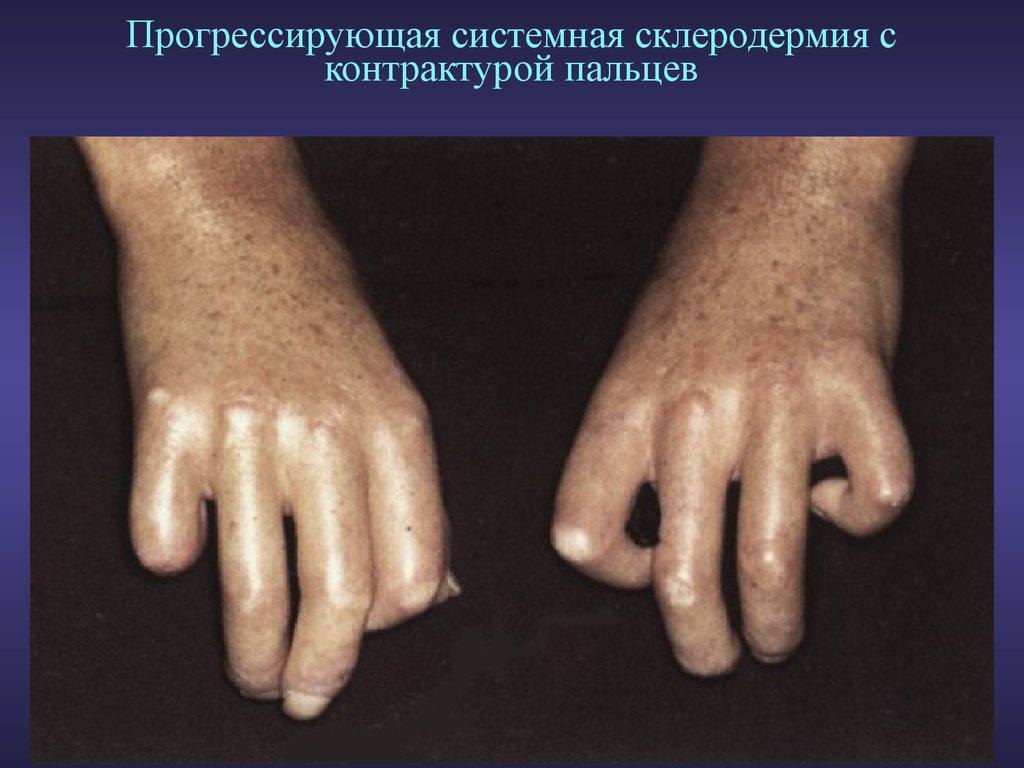 Прогрессирующая системная склеродермия с контрактурой пальцев