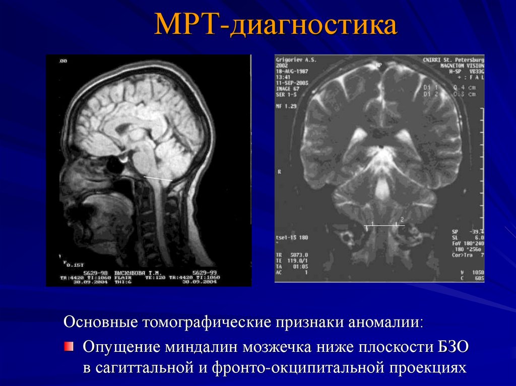 Миндалины мозжечка. Опущение миндалин мозжечка мрт. Опущение миндалин мозжечка в большое затылочное отверстие. Дислокация миндалин мозжечка. Пролабация миндалин мозжечка.