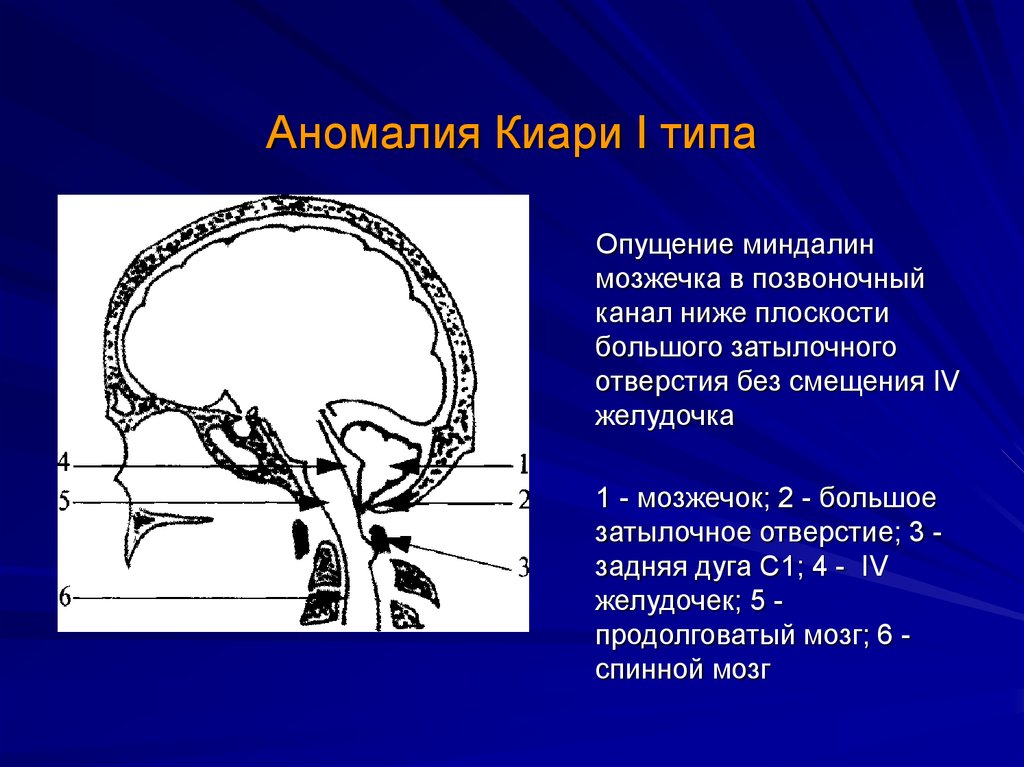 Миндалины мозжечка. Аномалия Арнольда Киари мозжечок. Опущение миндалин мозжечка мрт. Мальформация Киари 1 типа. Аномалия Арнольда Киари линия Чемберлена.